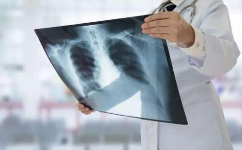 （奥西帕尼）肺癌前期的症状有那些？